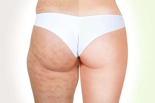 cellulite causes treatments