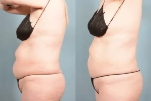 coolsculpting before and after