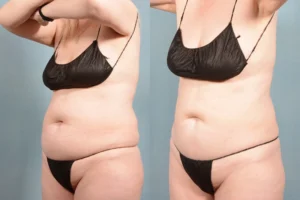 coolsculpting before and after