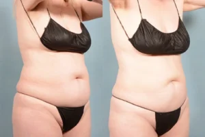 coolsculpting before and after