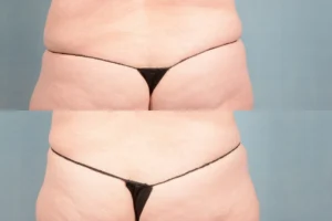 coolsculpting before and after