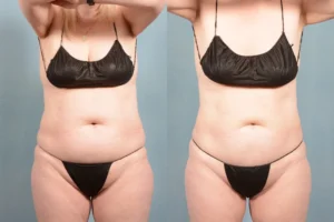 coolsculpting before and after