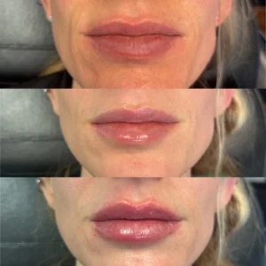 juvederm lip filler before and after