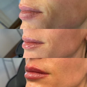 juvederm lip filler before and after