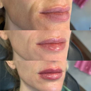 juvederm lip filler before and after