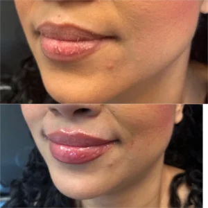 juvederm ultra xc lip filler before and after