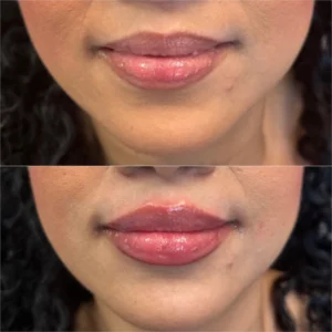 juvederm ultra xc lip filler before and after