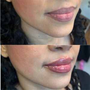 juvederm ultra xc lip filler before and after