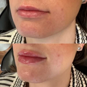 restylane lip filler before and after