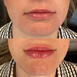 restylane lip filler before and after