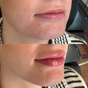 restylane lip filler before and after